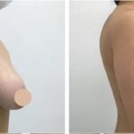 breast lift in dubai