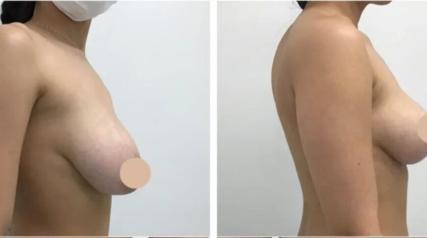breast lift in dubai