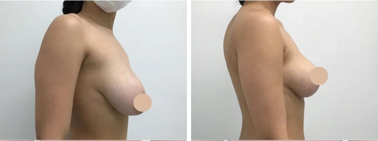 The Most Effective Ways to Speed Up Your Recovery After Breast Lift in Dubai