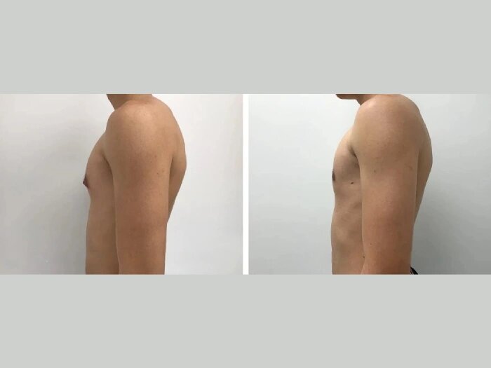 Finding the Right Gynecomastia Treatment for You in Dubai