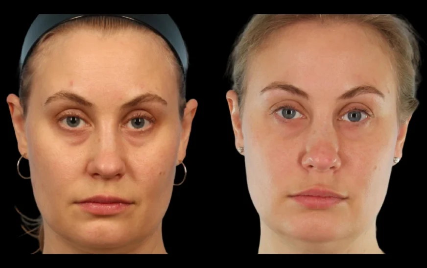 under eye fillers