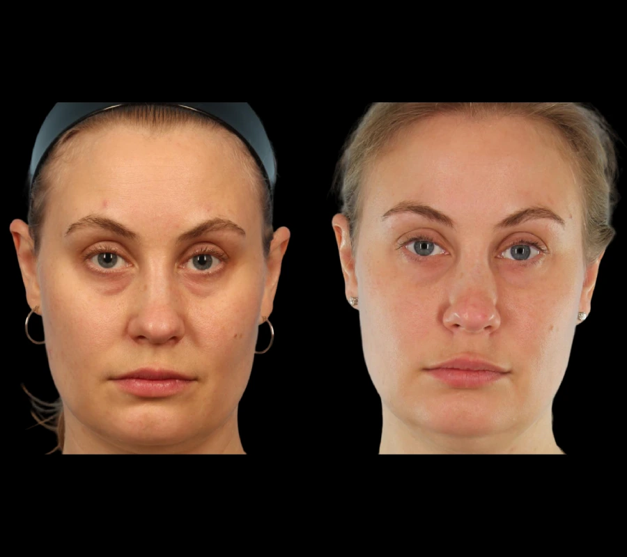 Under Eye Fillers from the Best Plastic Surgeon in Dubai: Can You Look Refreshed?