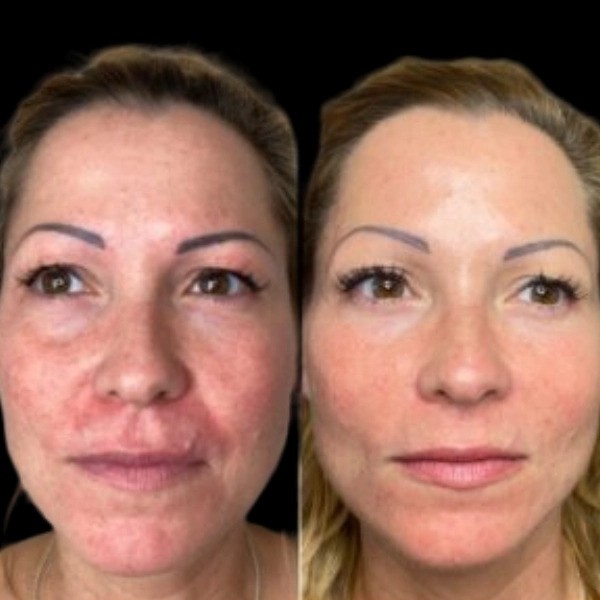 Is Profhilo Safe Advice from the Best Plastic Surgeon in Dubai