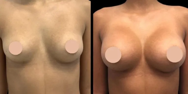 How to Choose Between Traditional Implants and Fat Transfer for Breast Augmentation in Dubai