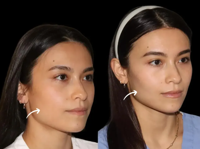 How the Best Plastic Surgeon in Dubai Handles Complex Reconstructive Cases with Sculptra Fillers
