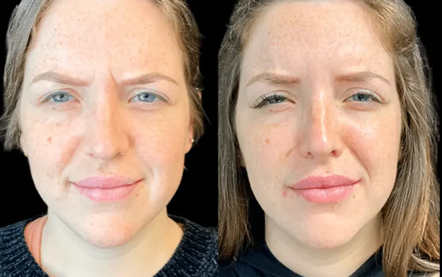 How Long Does Botox Last? Expert Insight from the Best Plastic Surgeon in dubai