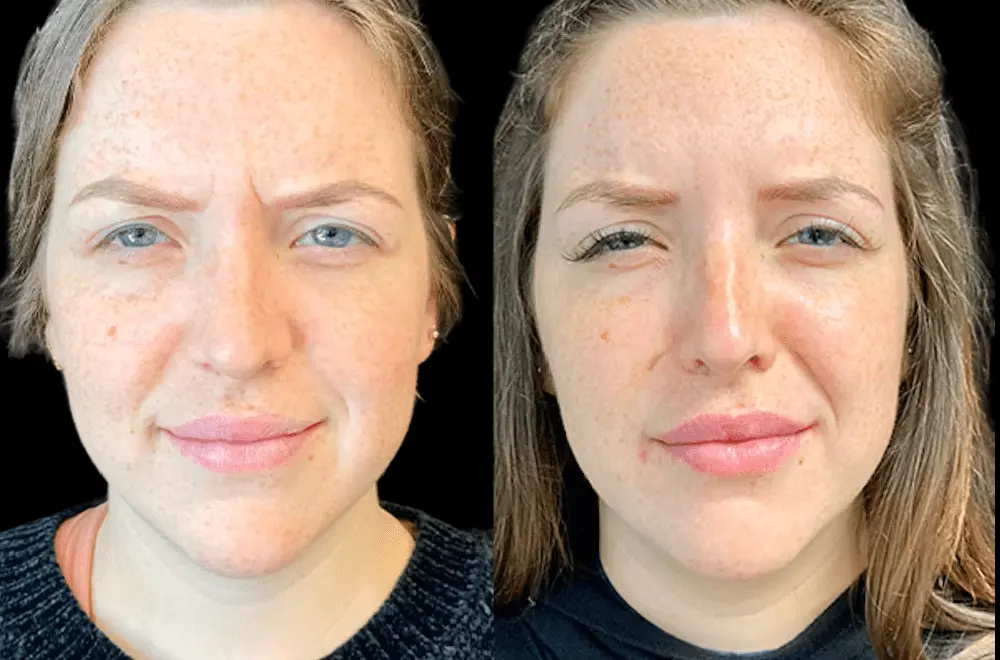 How Long Does Botox Last? Expert Insight from the Best Plastic Surgeon in dubai
