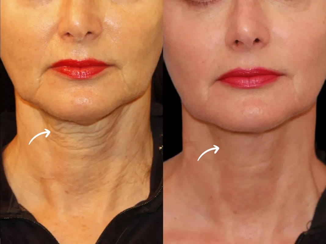 Lifestyle Tips with Sculptra by Best Doctors in Dubai