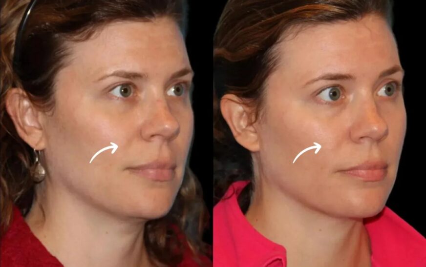 sculptra in dubai